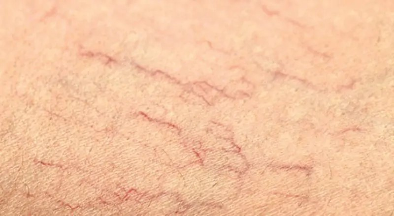 Giãn mao mạch là hiện tượng trên bề mặt da nổi lên các mạch máu li ti nhìn khá giống mạng nhện.