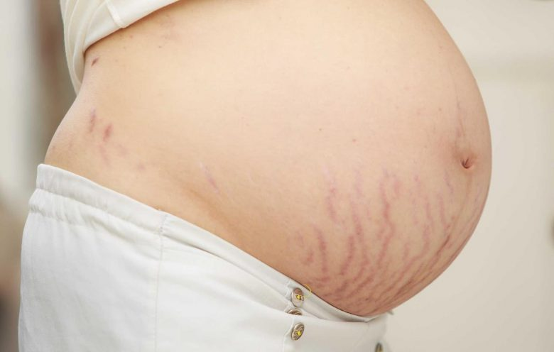 Rạn da bụng sau sinh không chỉ xuất phát từ việc mang thai mà còn đến từ yếu tố gen di truyền trong gia đình.