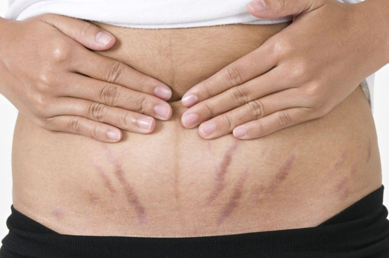 Vết rạn da bụng sau sinh có thể có màu đỏ, hồng, đen hoặc trắng bạch tùy thuộc vào giai đoạn và loại da của người phụ nữ.