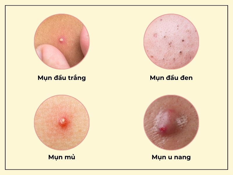 Hình ảnh minh họa các loại mụn trứng cá do da bị bít tắc lỗ chân lông.