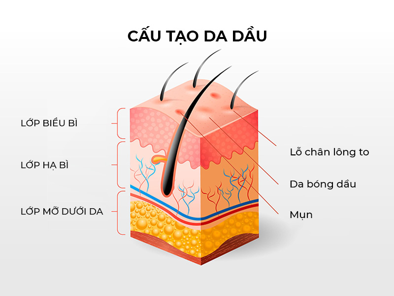 Những dấu hiệu nhận biết thường thấy của da dầu là: mụn, bóng nhờn, lỗ chân lông to,...