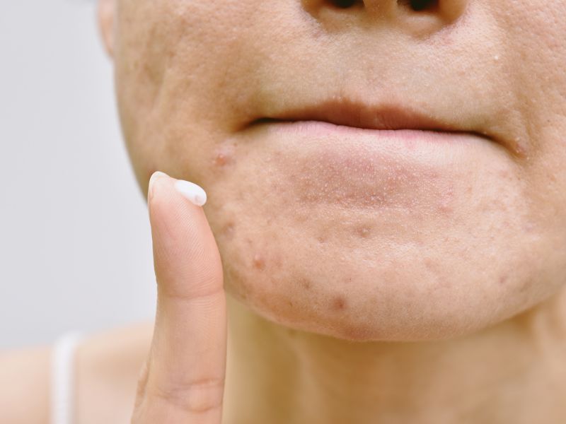 Việc sử dụng gel chấm mụn sẽ giúp cho những vùng da xung quanh không bị khô tróc thêm mà vẫn đảm bảo hiệu quả trị mụn.