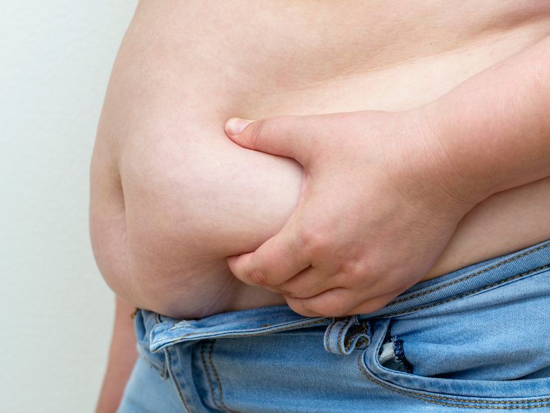 Thừa cân, béo phì cũng là một trong số những nguyên nhân phổ biến gây nên rạn da tuổi dậy thì.