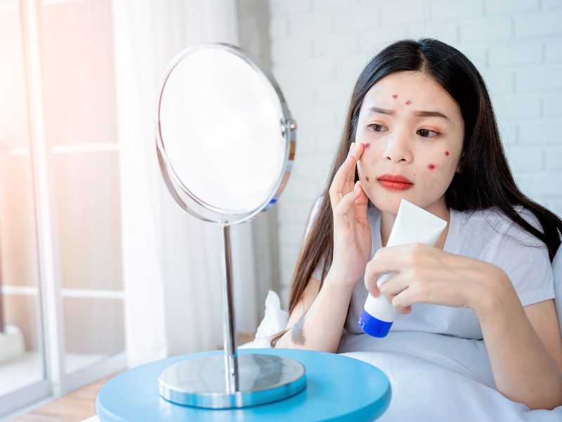 Kem chống nắng trong quy trình skincare sau khi nặn mụn giúp bảo vệ da toàn diện dưới tia UV.