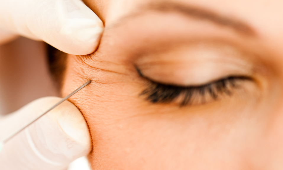 Botox có hiệu quả nhất đối với các nếp nhăn động do hoạt động của cơ tạo ra.